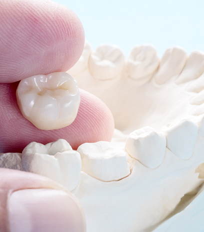 Model of teeth along with dental crown in Belmont, MA