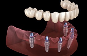 Diagram of an implant denture