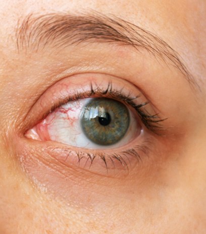 Close-up of eye before dry eye treatment