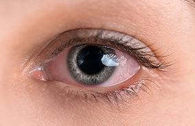 Closeup of patient with eye redness