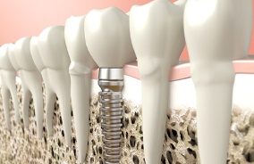 Dental implant in Belmont
