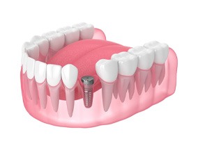 Render of dental  implant in Belmont, MA during osseointegration