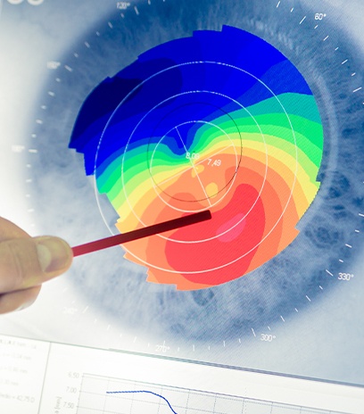 Corneal mapping technology used to design therapeutic contact lenses