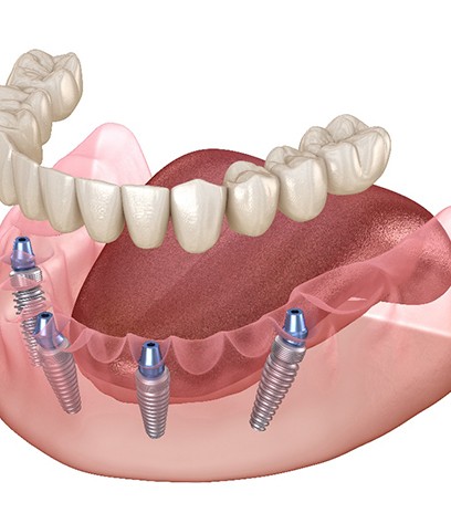  A 3D illustration of all-on-4 implants