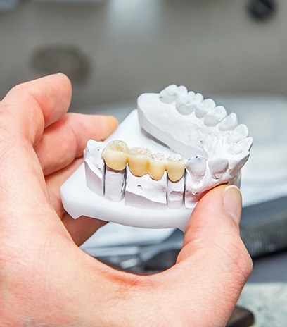 a model of a dental bridge in Belmont