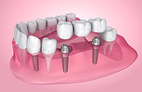 an example of an implant dental bridge in Belmont