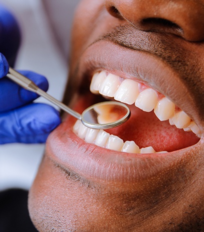 Dentist checking smile after tooth colored filling dental restoration