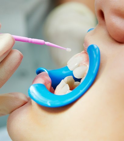 Child receiving fluoride treatment