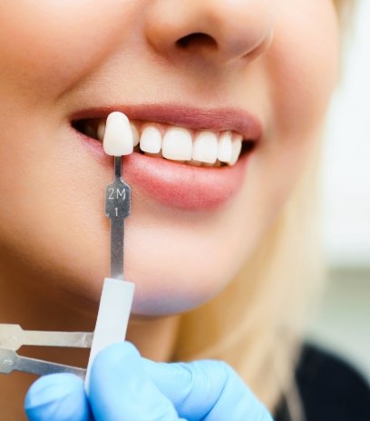 Patient's smile compared with porcelain veneer shade chart