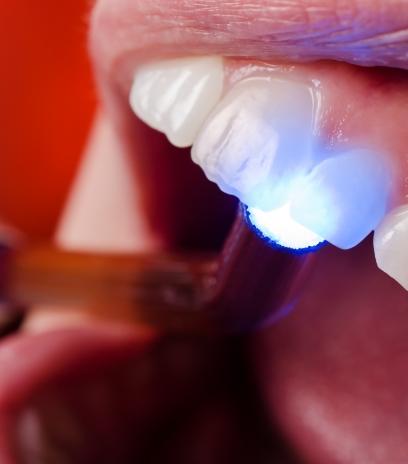 Patient receiving cosmetic dental bonding