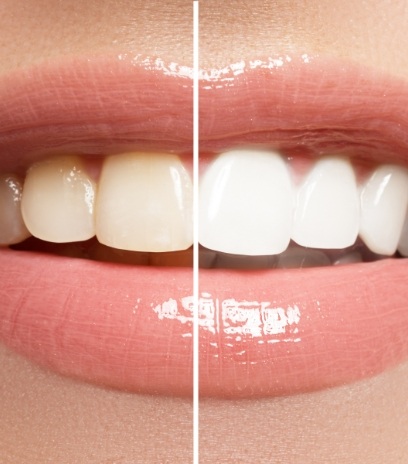 Smile before and after teeth whitening