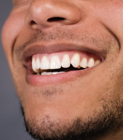 Smile after gum recontouring
