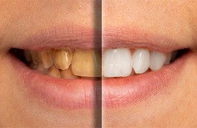 Smile before and after visiting cosmetic dentist in Belmont, MA