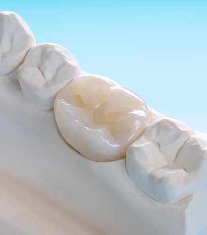 Model smile with dental crown restoration