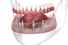 a digital image of all-on-4 dentures in Belmont