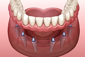 diagram of implant dentures
