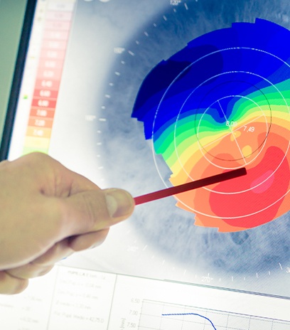 Corneal mapping technology used for dry eye treatment planning