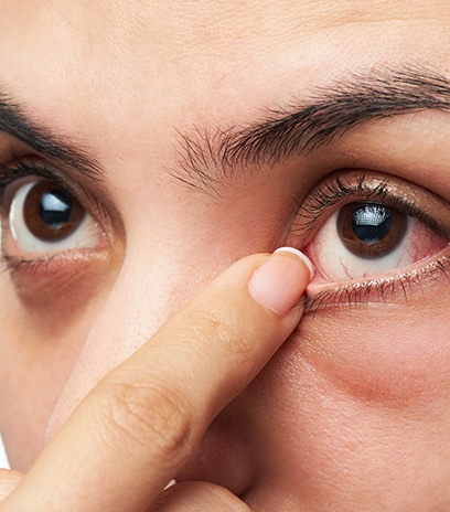 Woman pointing to eye after punctal plug treatment