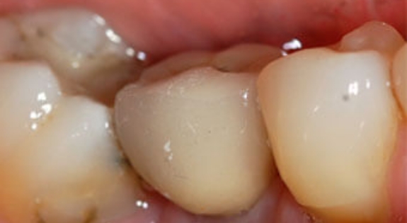 Smile after dental crown restoration is placed over the dental implant post