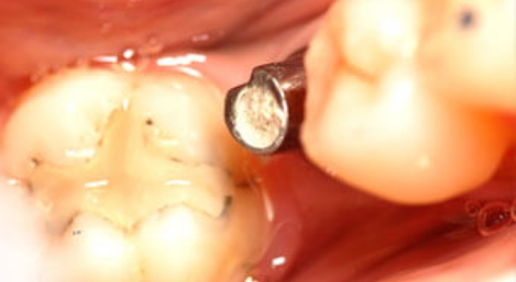 Smile with dental implant post visible