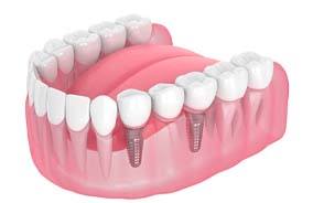 Dental implant bridge in Belmont