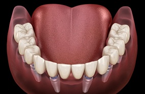 Implant denture in Belmont