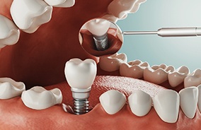 Diagram of an integrated dental implant in Belmont.