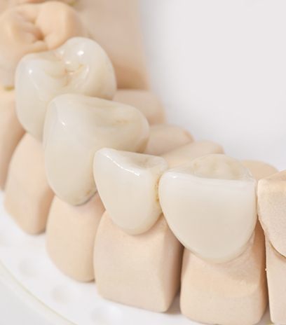 Model smil with dental bridge restoration