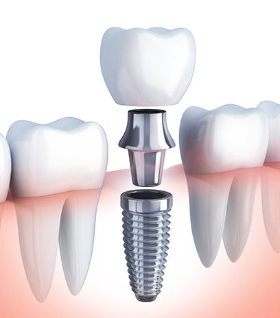 Animated dental implant supported dental crown