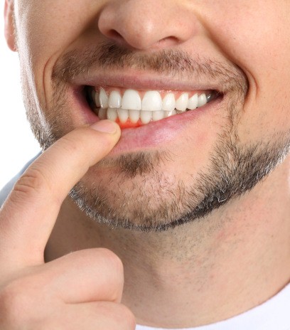 Man showing swollen gums in need of gum disease treatment in Belmont, MA