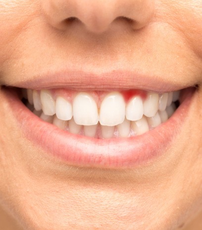 Close-up of smiling mouth with inflamed gums