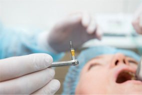 Dentist holding dental implant post during dental implant placement
