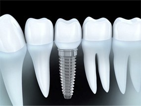 Dental implant in Belmont, MA with final crown attached