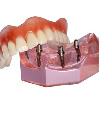 A model of implant-retained dentures in Belmont.