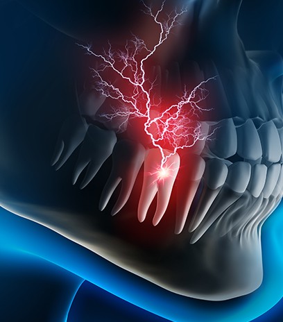 Animated tooth with lightning strike demonstrating toothache before root canal