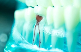 Model of a tooth to illustrate root canal in Belmont, MA