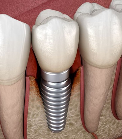 Illustration of infection around a dental implant