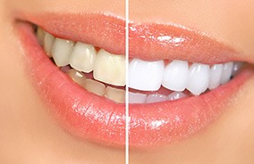 Close-up of smile before and after teeth whitening