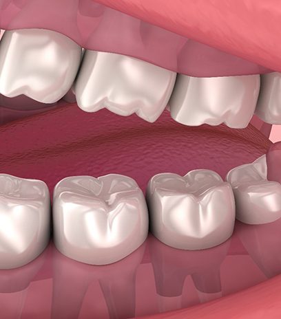 Illustration of a partially impacted wisdom tooth in Belmont, MA