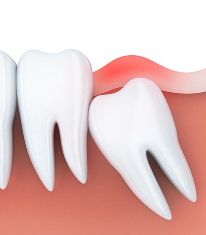 Animated smile with impacted wisdom tooth