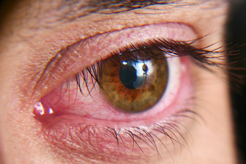 Close-up of a woman with red dry eye