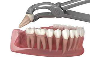 Illustration of tooth removed with forceps