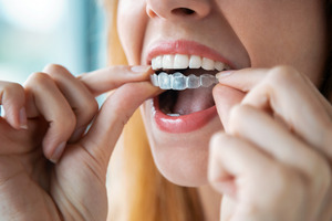Woman placing Invisalign on upper teeth